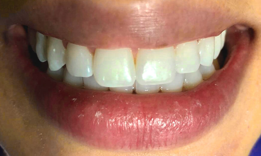 Dientes antes de colocar carillas