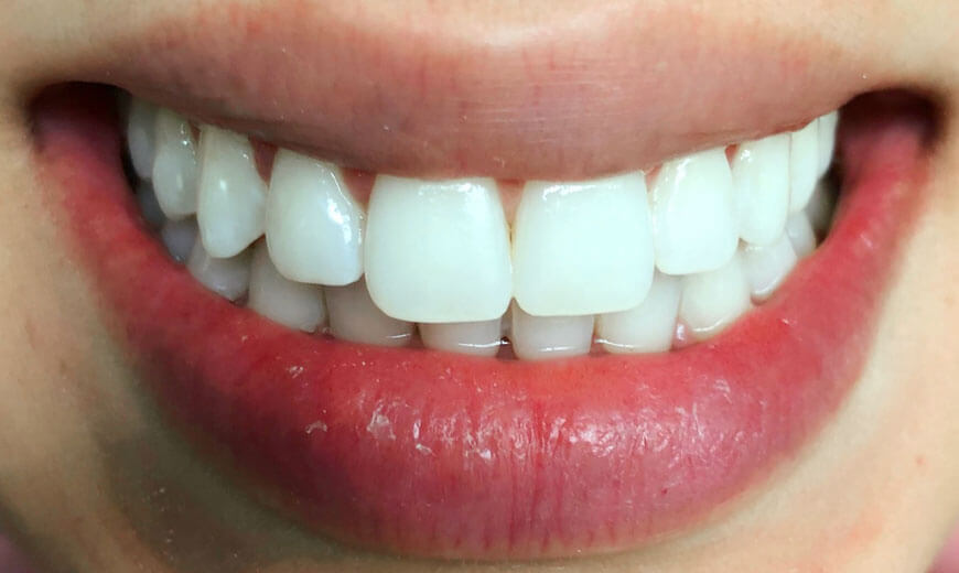 Dientes después de colocar carillas