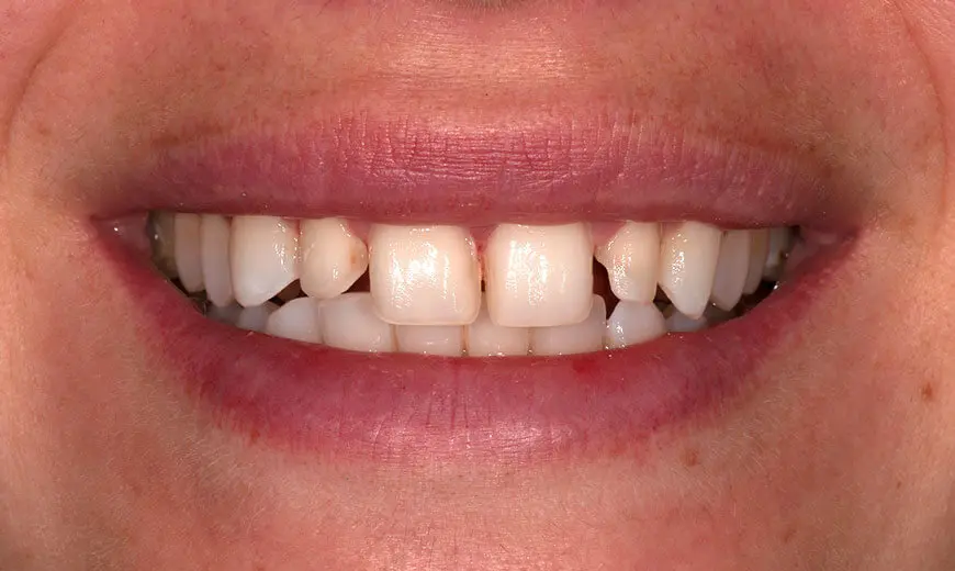 Dientes antes de colocar carillas