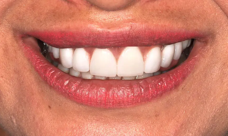 Dientes después de colocar carillas