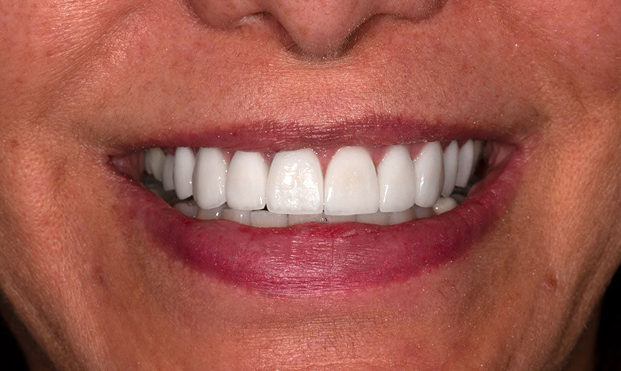 Dientes después de colocar carillas