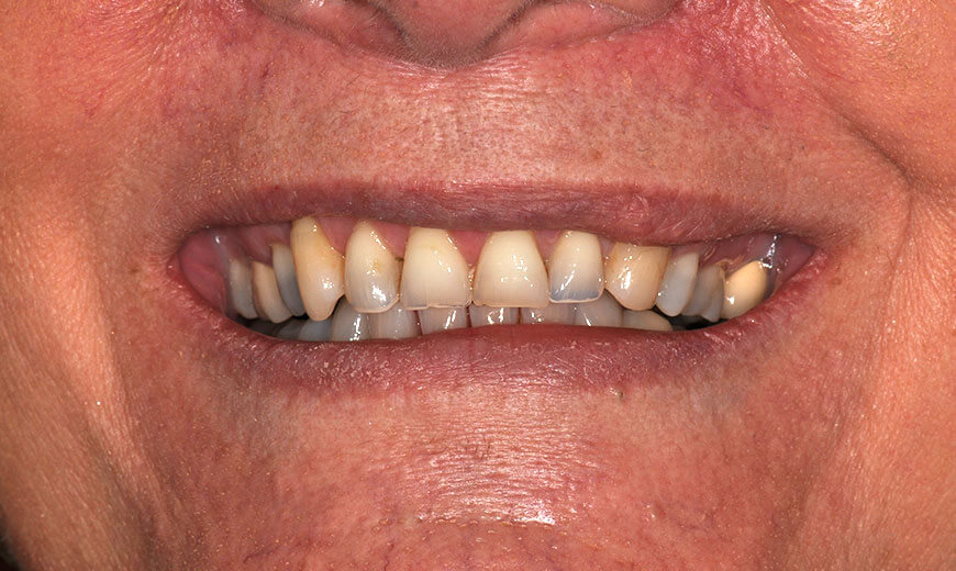Dientes antes de colocar carillas