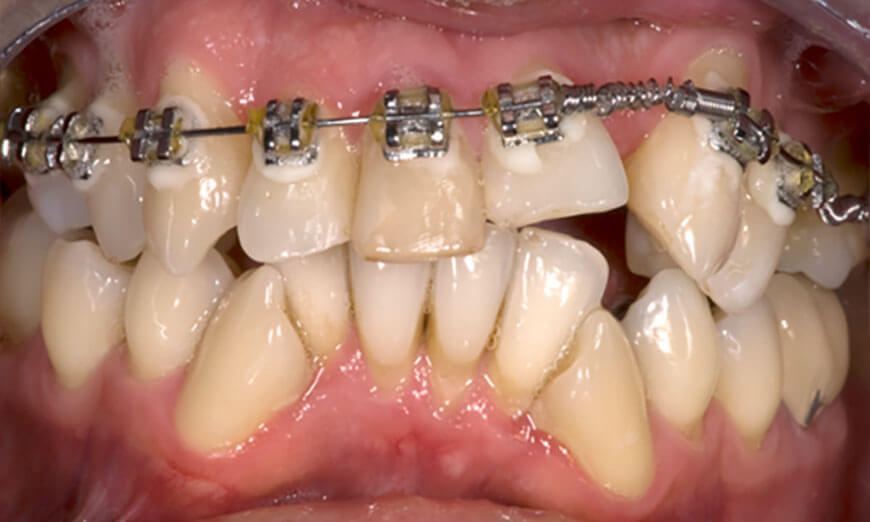 Dientes antes de colocar carillas