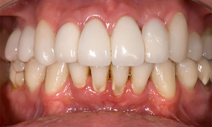 Dientes después de colocar carillas